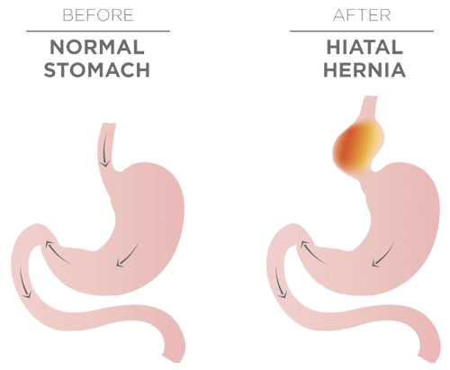 Get Hiatal Hernia Treatment At The Northwest Heartburn Center 0737