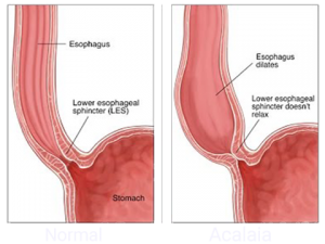 Achalasia Treatment At The Heartburn Center With NWMC Tucson